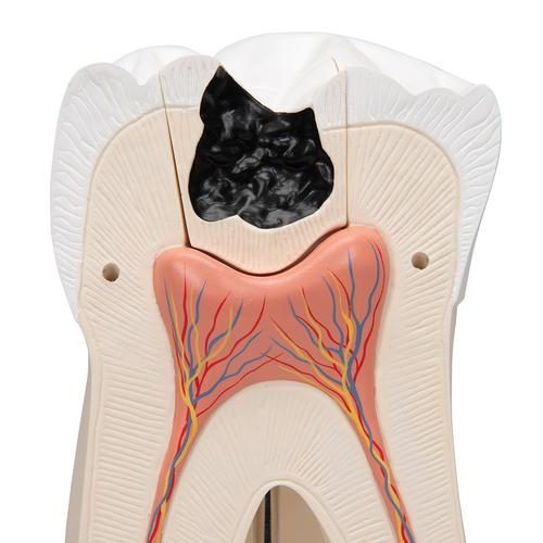 D15_06_Giant-Molar-with-Dental-Cavities-Human-Tooth-Model-15-times-Life-Size-6-part-3B-Smart-Anatomy.jpg