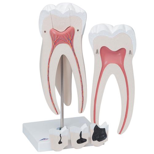 D15_10_Giant-Molar-with-Dental-Cavities-Human-Tooth-Model-15-times-Life-Size-6-part-3B-Smart-Anatomy.jpg