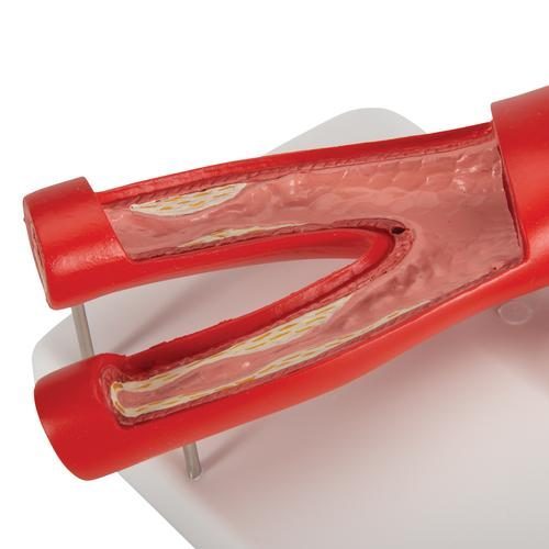 G40_08_Arteriosclerosis-Model-with-Cross-Section-of-Artery-2-part-3B-Smart-Anatomy.jpg