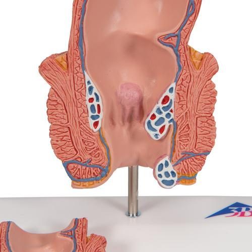 K27_08_Hemorrhoid-Model-3B-Smart-Anatomy.jpg